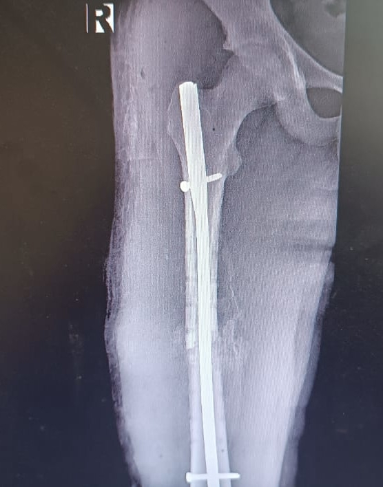 В Муроме теперь могут лечить переломы трубчатых костей у детей